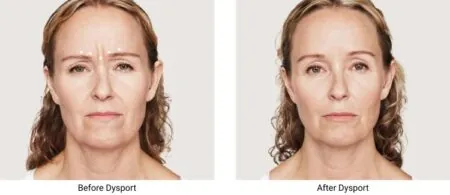 Side-by-side photos show a woman's transformation after treatment with Dysport, a Botox alternative.