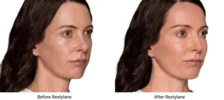 Side-by-side photos show a woman's facial transformation after treatment with Restylane dermal fillers.