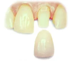 Photo showing an all-ceramic crown (such as one made of zirconia) about to be affixed to a prepared tooth.