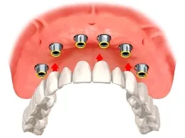 Implant supported dentures