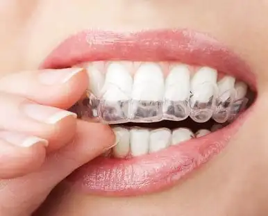 Teethe whitening trays being placed on teeth