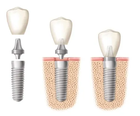 Illustration of a dental implant